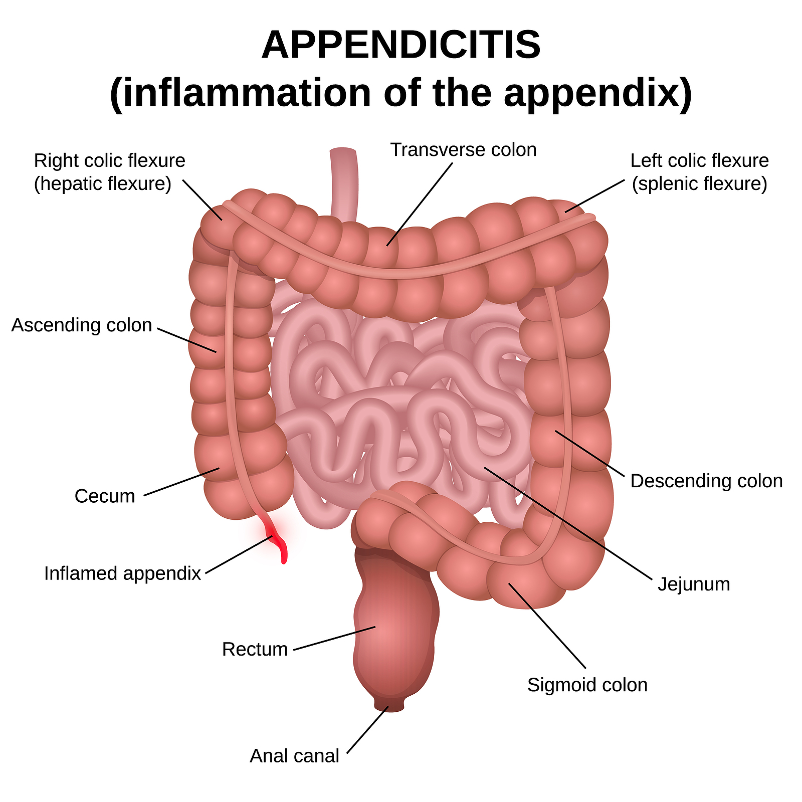 Appendicitis