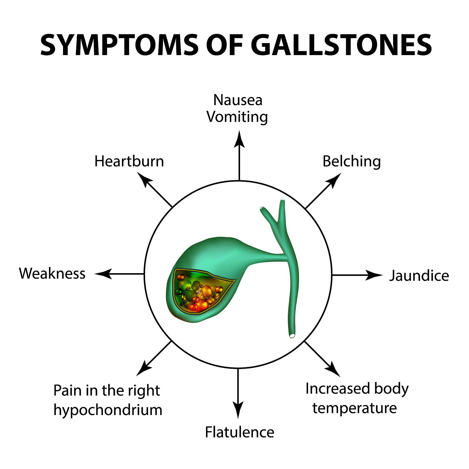 Gallstones